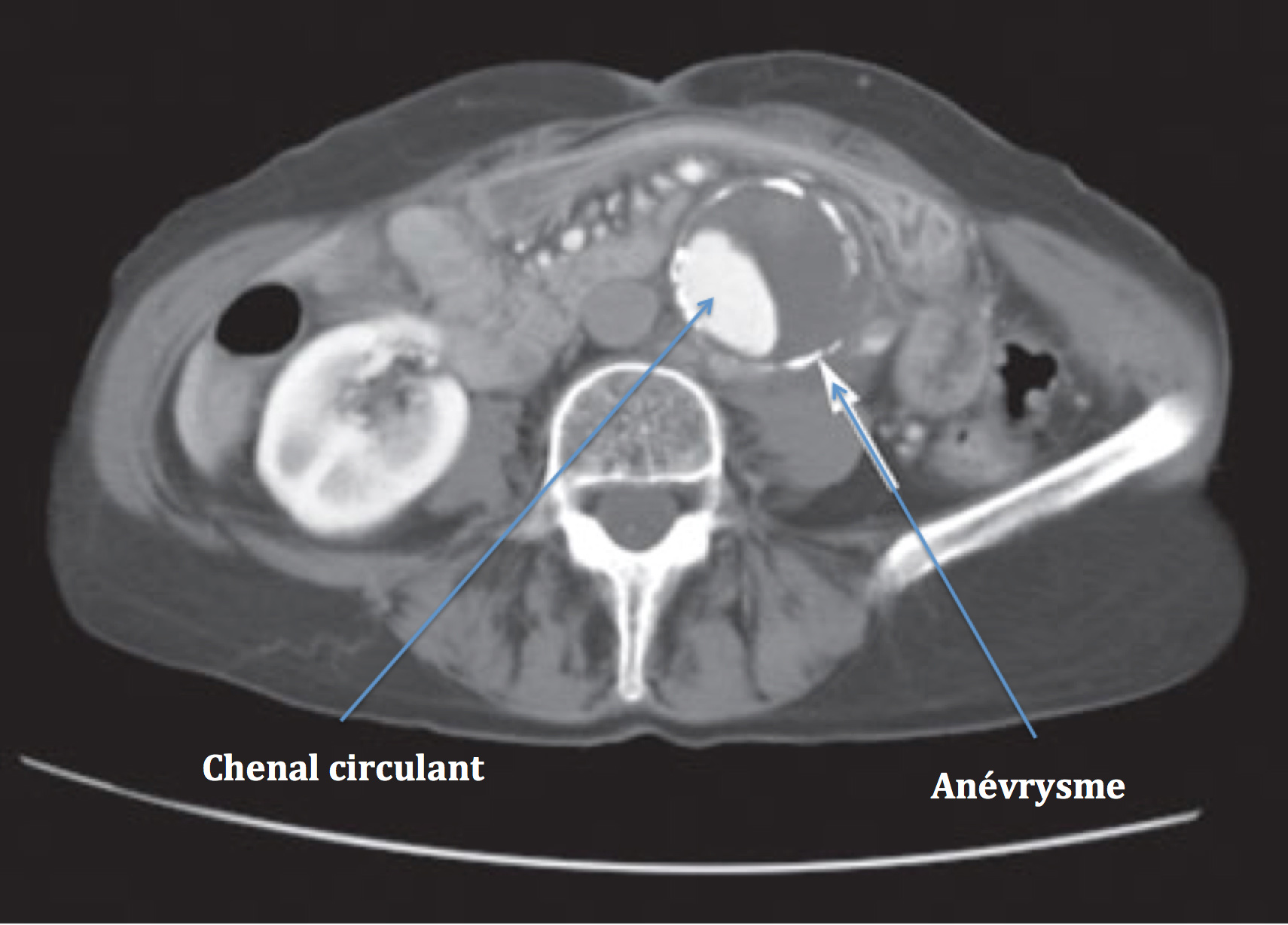 Symptômes Anévrysme - Diagnostic Anévrysme