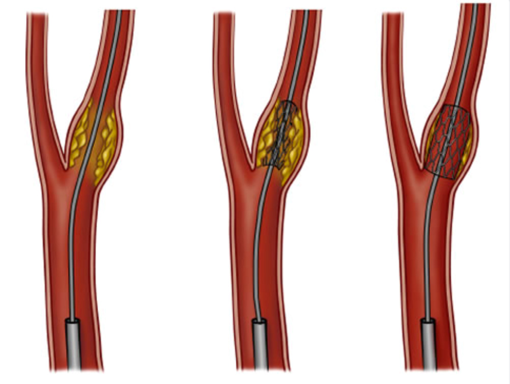 Angioplastie carotidienne